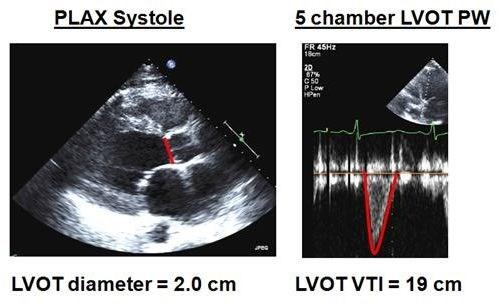 LVOT areal x LVOT VTI =