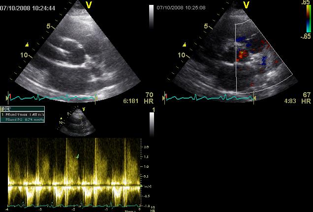 Trygkgradient (endediastole) over pulmonal+