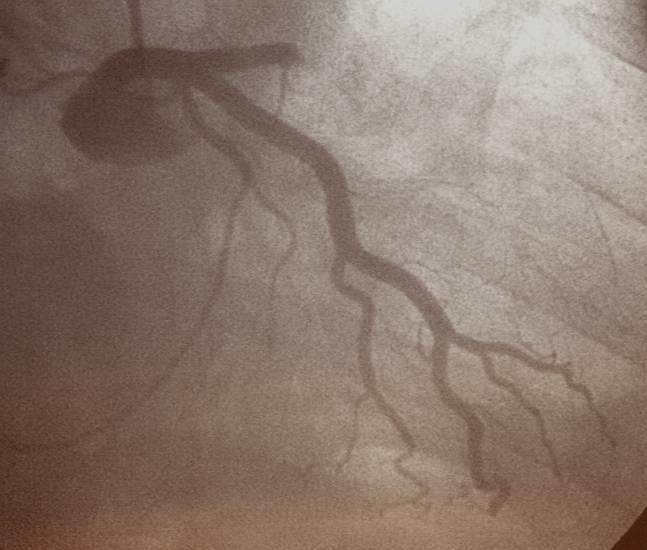 Most frequent cause of acute new-onset HF: Acute