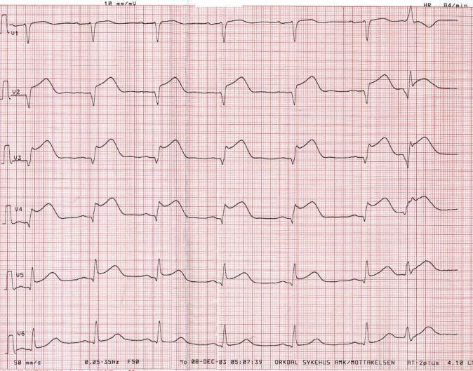 In-hospital mortality in cardiogenic shock 40-60%.