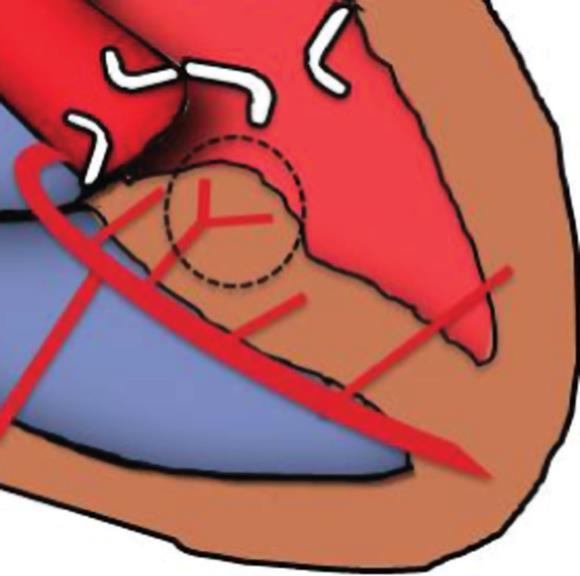 The most interesting finding of this study is,, that the all-cause mortality seems to be independently associated with the magnitude of residual left ventricular