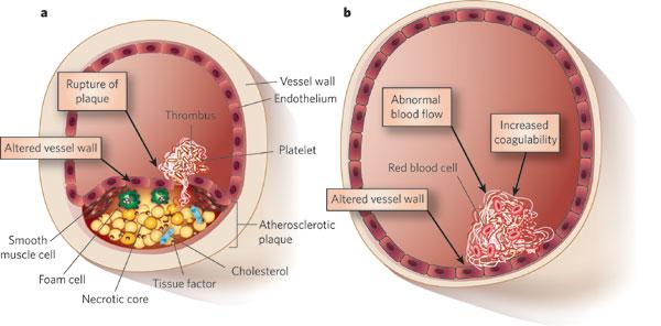 a: Arterial thrombosis b: