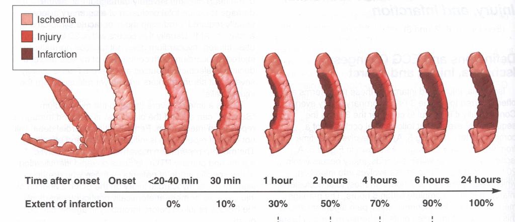 Myokardnekrose Starter 30-45min etter okklusjonen Etter 90min er 40-50% nekrotisert Etter 6t er nekrosen ofte fullstendig