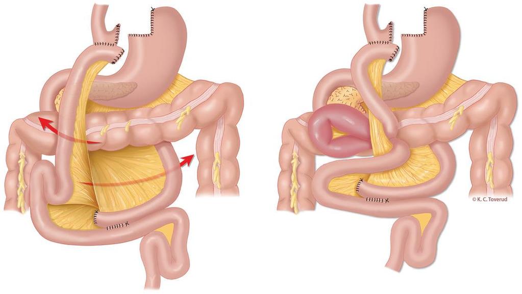 Intern Herniering