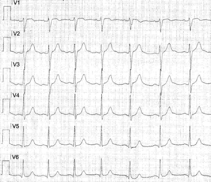 12: Treningsstudio Etter ferdig trening uvel, brystsmerter EKG tatt i ambulanse