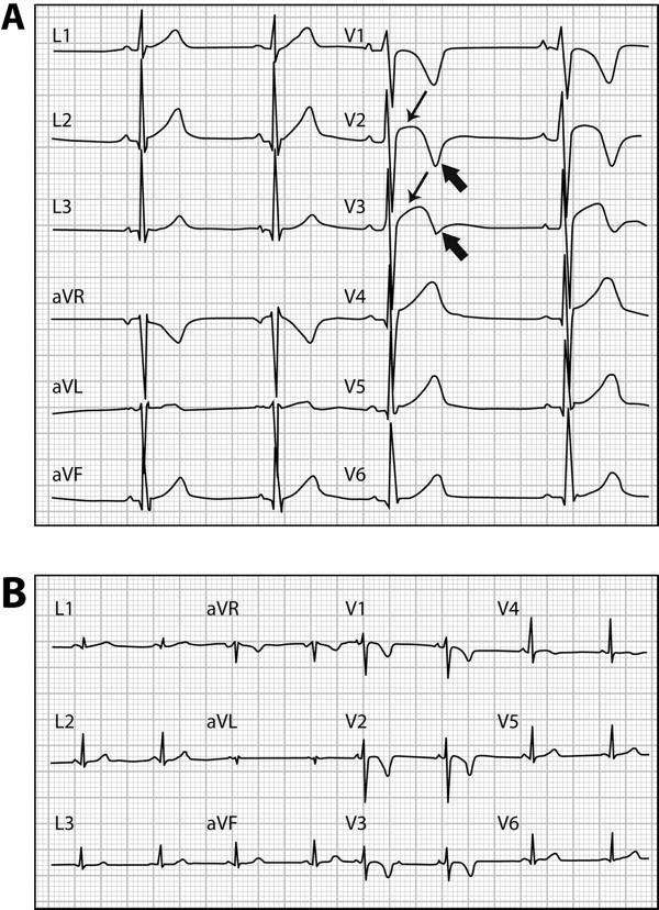 (A) Early repolarization pattern in a healthy black athlete characterized by B )right (B) precordial T-wave inversion (arrowhead) preceded by