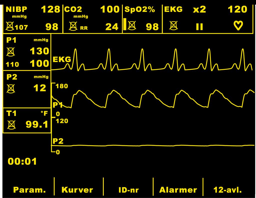CCT-defibrillatorens skjermvisning Skjermvisningen hos CCT-defibrillatoren er lik den du finner hos standard M Series defibrillatorer, med følgende unntak: CCT-defibrillatoren viser tre kurver