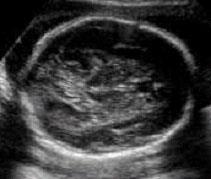 1 Måleteknikker 1.1.1. Måling av fosterhodet: Biparietal diameter (BPD) og hodeomkrets (head circumference- HC) er de mest brukte biometriske mål fra fosterets hode.