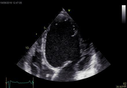 Hjertesvikt Symptomer og tegn. Definition of heart failure Clinical syndrome.