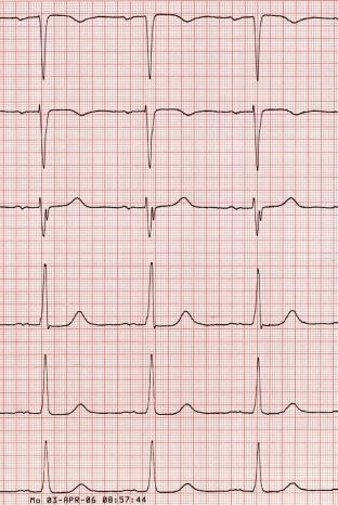 of left ventricular function. Am J Cardiol 1995;75:220-3. EKG ved hjertesvikt Arytmier?