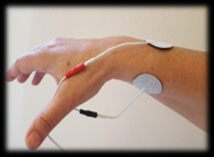 Elektrodeplassering Elektrodeplassering: Svart elektrode plasseres tre fingerbredder frahåndleddet på innsiden av underarmen, akupunkturpunkt P6. Rød elektrode plasseres på underarmens overside.