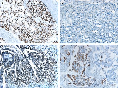 P53 P53, komplett negativ WT1 P16 Lee SH et al.