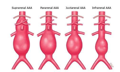 Typer abdominale aortaaneurismer (AAA) Suprarenale Pararenale