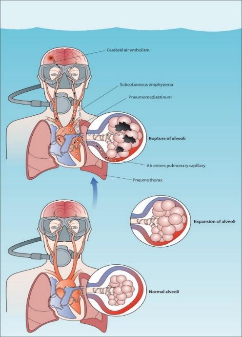 Figur 7. Bobledannelse i blant annet hjernen etter lungebrist (pneumothorax) (23).