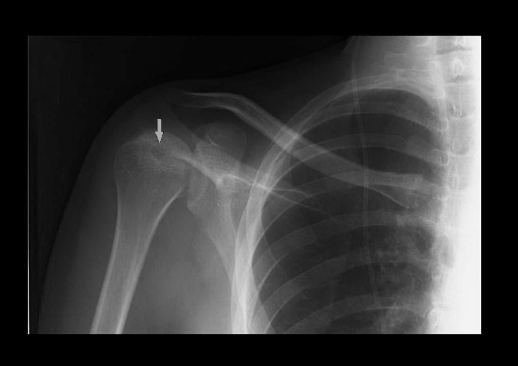 år og de radiologiske funnene viste ingen progresjon. Forekomsten av DON har blitt signifikant mindre i løpet av de to siste tiår (195). Likevel kan DON være et problem i utviklingsland.