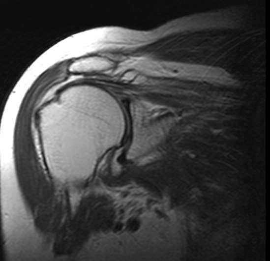 Rotator cuff ruptur Traumatisk eller degenerativ Terminologi Partiell Leddside Bursaside