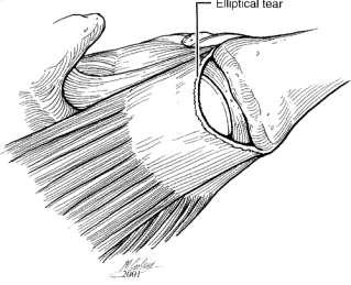 Full tykkelse rotator cuff ruptur Traumatiske; operasjon