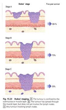 Histologisk grading av diferensiering Examples of Tumour nomenclature Type Benign Malignant Epithelial Squamous cell Squamous cell papilloma Squamus cell carcinoma Transitional Transitional cell