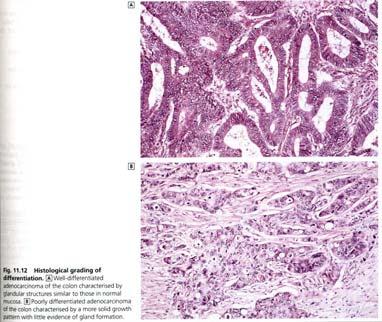 thyroid adenoma) (e.g.