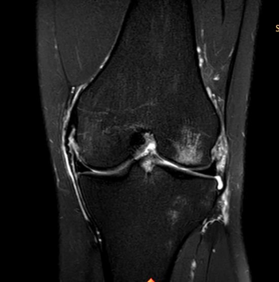 ruptur/lesjon Obs for lateral