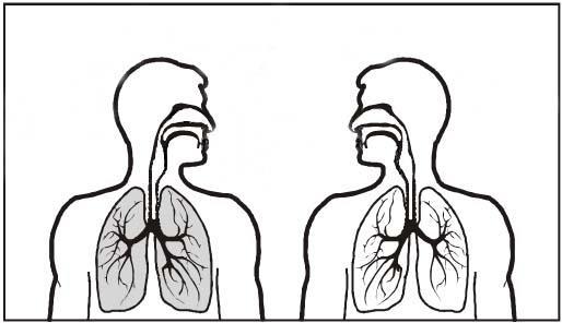 Lungetuberkulose er mindre smittsomt enn du tror!