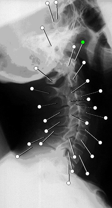 Ødelegge nerver i nakken 1. Press hodet fremover til det stopper. Nesen mot brystkassen. 2. Vri haken så mot himmelen. Husk plassering av hendene. 3. Slå med åpen hånd på cervical 1-4.