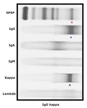 Immunofiksering Brukes til å bestemme hvilken type m- komponent, IgG/A/M og kappa/lambda