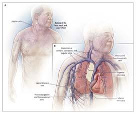 Vena cava superior syndrom Kasuistikk