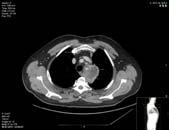 Lavt BT, AF, elektrokonvertert Respirator, dialyse, faecesinnstillasjon, hemicolectomi Poliklinikken 23/10: Gjenoppta strålebehandlingen? Immunterapi? Annet?