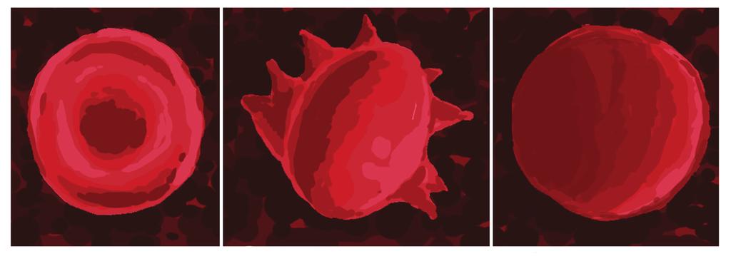 a) Normal blodcelle c) Hyperosmotisk miljø b) Hypoosmotisk miljø Fig. 5 Hypo- og hyperosmotisk påvirkning av røde blodceller I venstre del av figur 5 ser du en normal, rød blodcelle en erytrocytt.