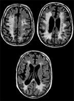 Alzheimer kontra Vaskulær demens: Ofte overlappende former,i opptil 20 % av tilfellene. Aldersdemens har blandingssymptomer fra disse to formene for demens.