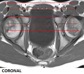 T1 TRA 160 3,5/ 10 % 0,42 x 0,62 Fra over acetabelum og forbi inferior pubic ramus.