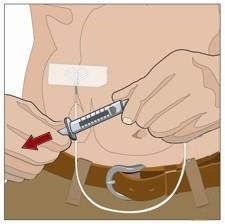 12. Kontroller at nålen er plassert riktig før du starter infusjonen hvis helsepersonell har gitt instruksjoner om det. 13.
