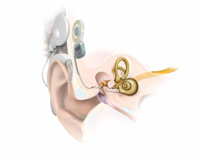 Spole 3 Mikrofon 1 4 Implantat Audioprosessor 2 5 Hørselsnerve Elektrodekontakter Slik fungerer et cochleaimplantat Et cochleaimplantat omdanner lyd til elektriske impulser.