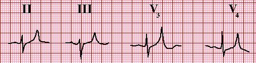 K: EKG