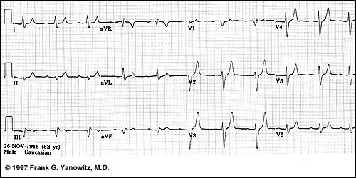 K: EKG