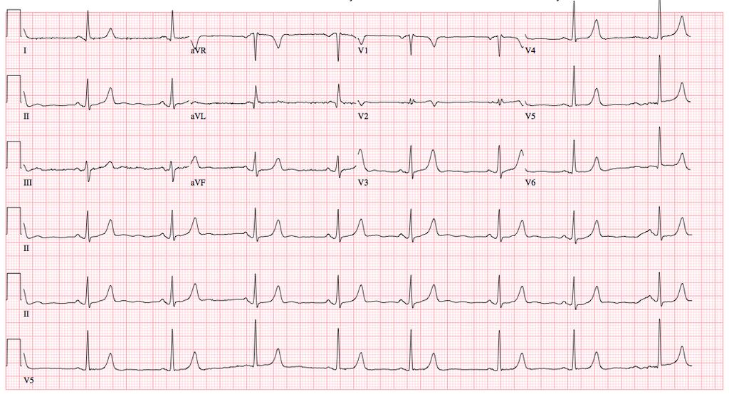 K: EKG