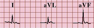 Ca: EKG