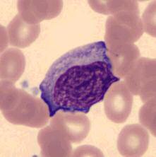 LUC Mono Jeg skal ved hjelp av to kasus analysert på Xe2100, advia120 og mikroskopisk på dm96, belyse noen av utford ringene vi møter hver dag på enhet for hematologi.