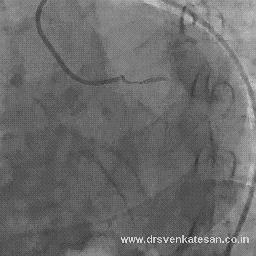 Kasuistikk 4 Nylig PCI-behandlet, dobbel-platehemmet, 65 år gammel mann, med normalt A-EKG, nå vage symptomer uten bedring av NG, negative