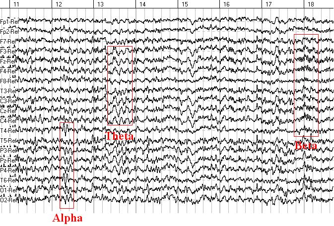 Seven sec. EEG from 19 sites.
