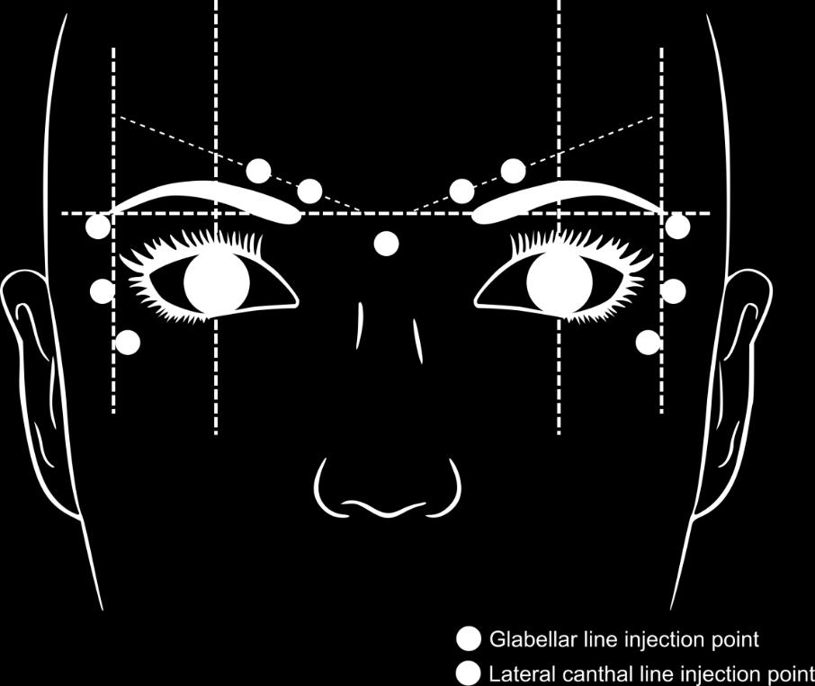 Anbefalte områder for injeksjon ved glabellalinjer og laterale kantale linjer er beskrevet under: Glabellalinjer Den anbefalte dosen er 50 Speywood-enheter (0,25 ml av rekonstituert oppløsning) med