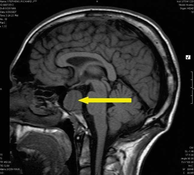 hypofysesvulster 1 lavgradig gliom 1 acusticus-nevrinom Inkrakraniale vakulære aneurismer