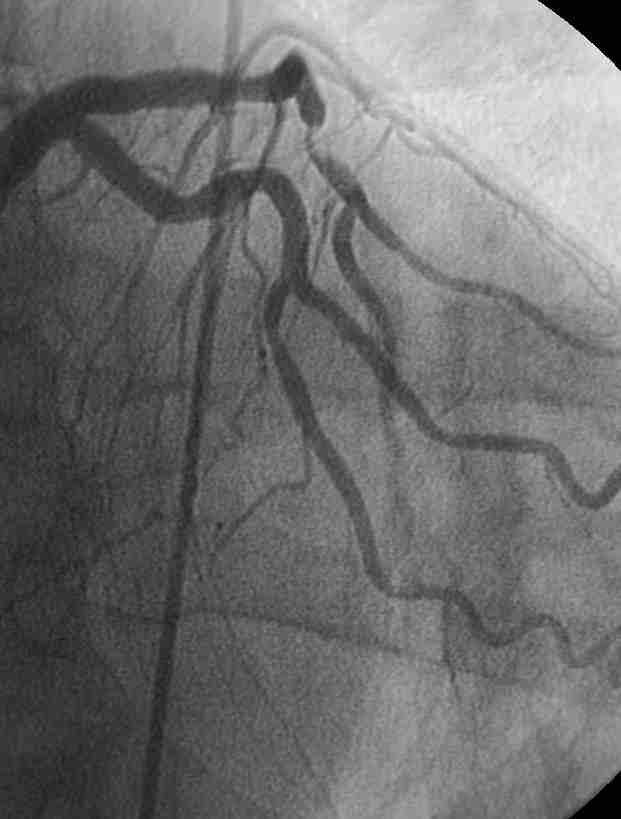 Behandling av SCAD Optimal medisinsk behandling (OMT) ASA trombose profyl Statin plakk stabil.