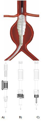 Anlegge aortadelen av hoveddelen Anlegge den ipsilaterale grenen Anlegge aortadelen til graftet: A) Trekk skjedekontrollen