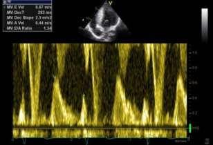 Mitral inflow