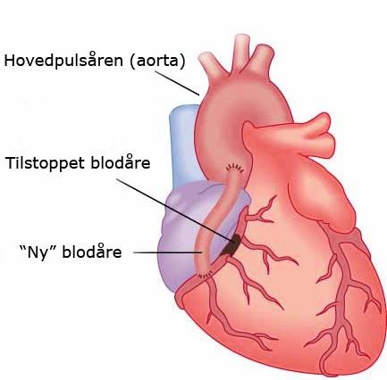 Om bypassoperasjon (ACB) Forsnevring (stenose) eller tilstopping (okklusjon) av hjertets kransårer (koronararterier) fører til at hjertemuskulaturen får for lite blod og dermed for lite oksygen.