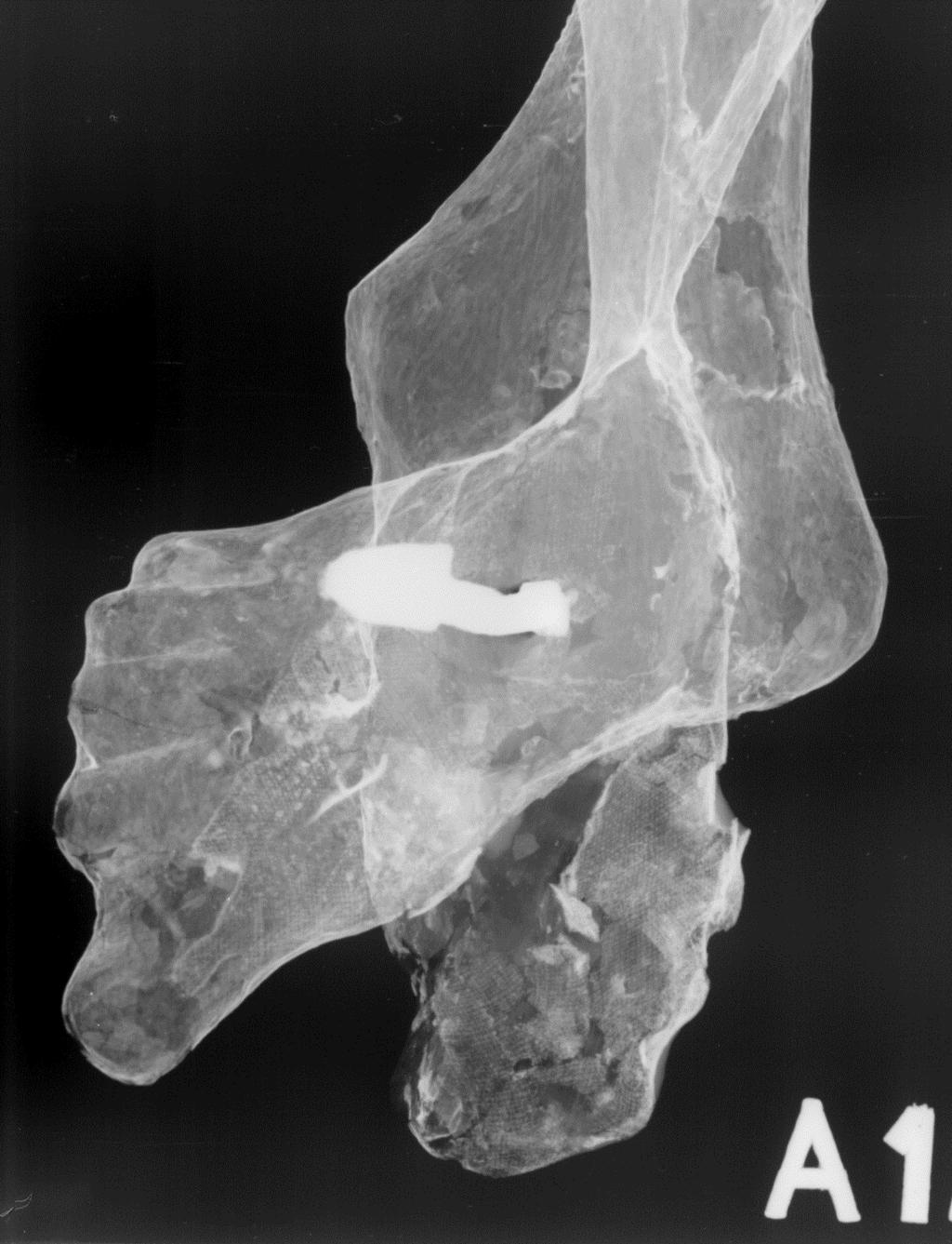malingsavskalling Lerret ligger over de utskårne tærne Opphoping av sekundær røntgenabsorberende maling Synlig lerretstekstur Figur 25 Røntgenbilde av krusifiksets føtter sett ovenfra.