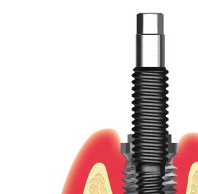 den inn i implantatet med klokken ved bruk av