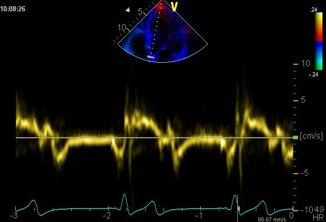 Vevshastigheter, pulset Doppler Interventrikulær